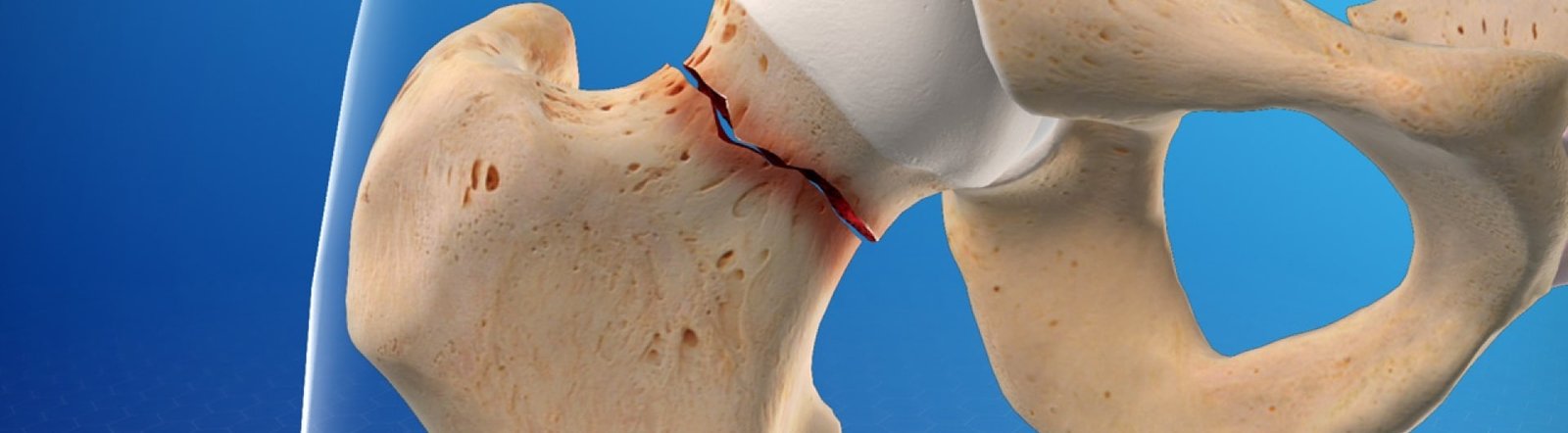 Hip Fracture Treatment