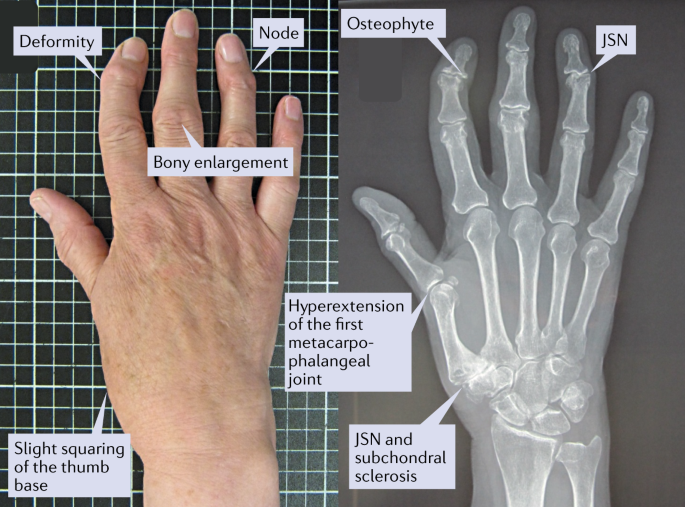 Genetic predisposition in Osteoarthritis