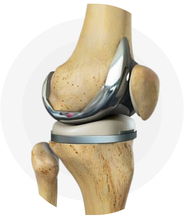 Knee Replacement